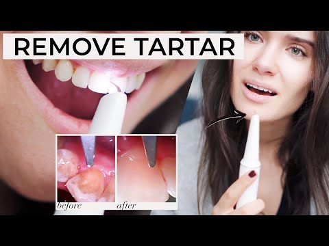 HOW TO REMOVE PLAQUE TARTAR AT HOME | Ultrasonic Tooth Cleaner Review - Does It Work?!