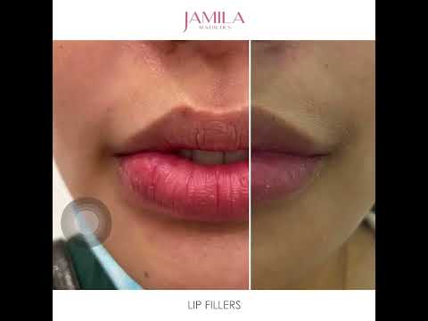 Jamila Aesthetics Lip Filler - Kissable Lips - Before & After