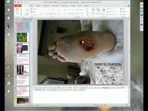 Medical School Pathology 2012 Session 074 Nerve-Muscle.mp4