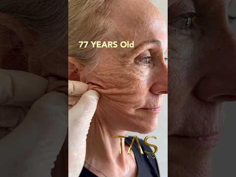 77 Years Old to 30 Years Old by Prof.TAS with Scarless #Facelift