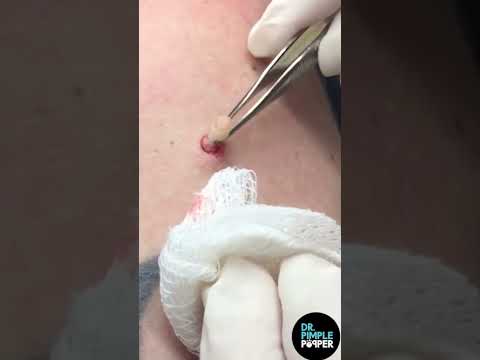 A Hard Pops Medley by Dr. Pimple Popper