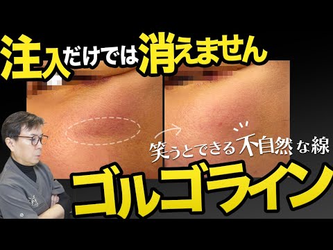 【ゴルゴライン】笑った時にでる不自然な線。ヒアルロン酸注入だけでは治りません！中顔面骨膜下リフトやフェイスリフト、裏ハムラや表ハムラのついでに治せる！リガメントを切断することが重要です！