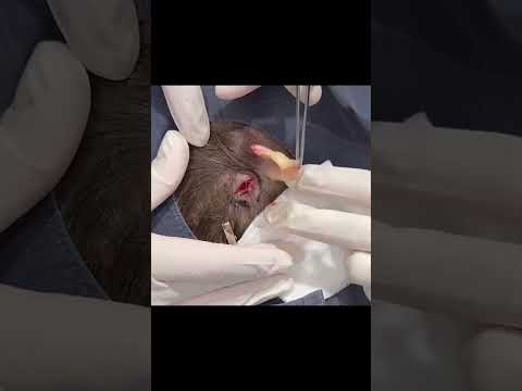 Out of this World Pilar Cyst