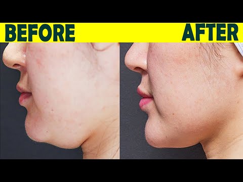 How to Lose Double Chin | Here Are Five Ways to Do It | Top 5.