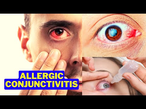 eye flu treatment Homeopathy medicine for red eyes  | conjunctivitis | allergic conjunctivitis