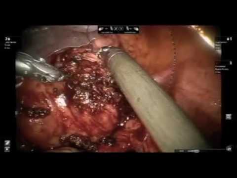 Robotic Myomectomy by Dr Rooma Sinha  Apollo Hospital, Hyderabad, India   YouTube 360p