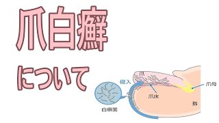 富山労災病院 皮膚科「爪白癬について」令和４年９月