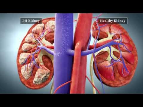 Primary Hyperoxaluria Mechanism of Disease