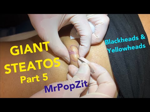 Giant Steatocystomas part 5. Butter bumps, blackheads, and the rarely seen yellowhead extractions