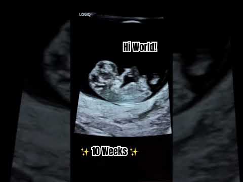 10 weeks pregnant ultrasound scan! #shorts