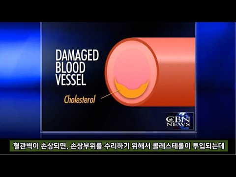 콜레스테롤은 잊어라! 염증이 진짜 적이다 [CBN News 2013/2/4]