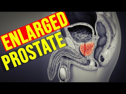 How to Treat Enlarged Prostate | 5 Effective Natural Remedies for Enlarged Prostate.