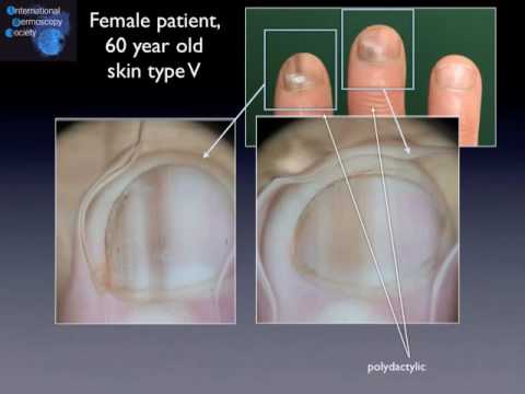 Nail pigmentation (advanced level) by Dr. Luc Thomas