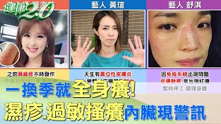 一換季就全身癢！ 濕疹、過敏搔癢內臟現警訊 健康2.0