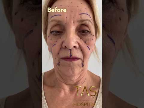 One of the most amazing transformations 🚀 from 74 years old to 30 ? #facelift #drsuleymantas