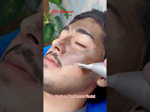 Carbon Peel Laser Facial #getsmarthairclub #hair #viralvideo r