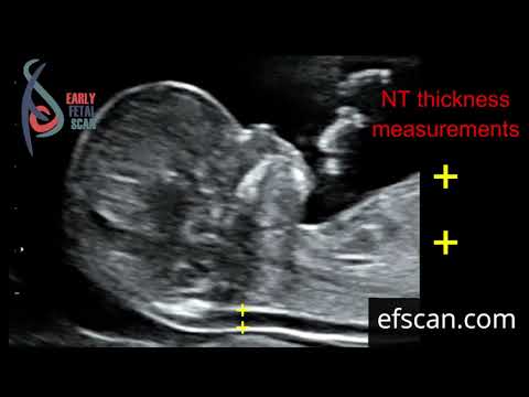 Nuchal translucency (NT) thickness measurement: for Early Fetal Scan Conference 2019