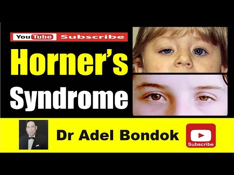 Horner's Syndrome, Dr Adel Bondok Making Anatomy Easy