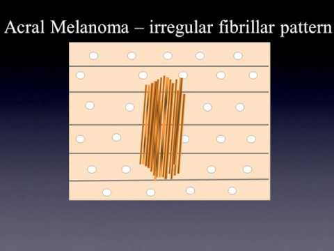 Acral melanoma by Dr. Dr. Rainer Hofmann-Wellenhof