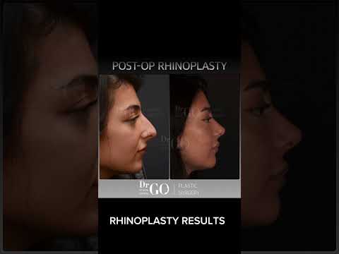 Before and after Rhinoplasty - Dr Guncel Ozturk #beforeandafter #rhinoplastyturkey #drgo