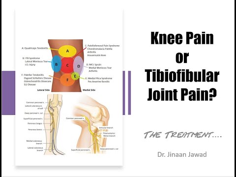 How To Treat Knee Pain? The Treatment -- Part 2