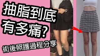 【抽脂有多痛！？】大腿環抽+腹部背部抽脂，術後照護過程分享(上)