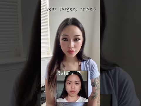 Luna's 1year surgery review!