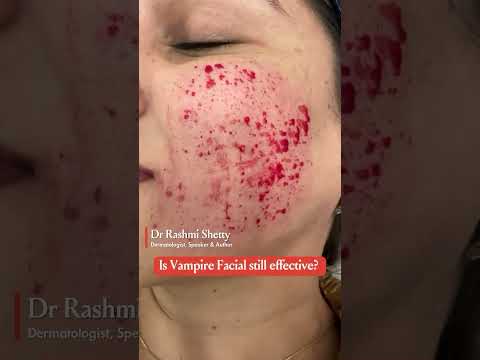 All about Vampire Facial - By Dr Rashmi Shetty