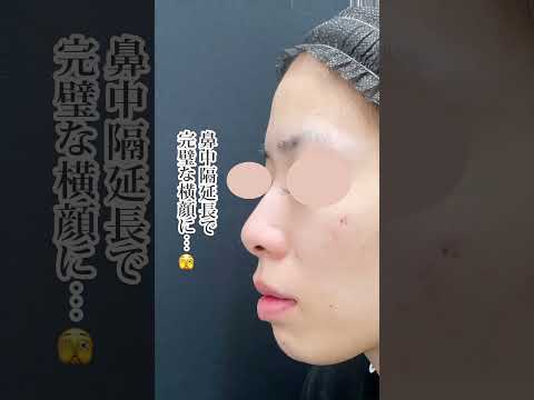 鼻中隔延長(鼻中隔軟骨)＋鼻尖形成3D法＋鼻尖部軟骨移植【形成外科専門医の鼻整形】 #形成外科専門医 #鼻整形 #鼻整形ダウンタイム #鼻中隔延長