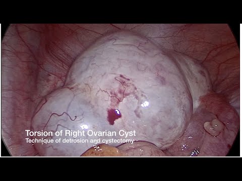 OVARIAN CYST TORSION- laparoscopic management Dr Rooma Sinha apollo Hyderabad