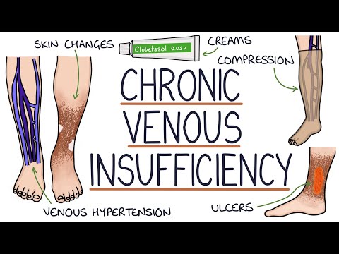 Understanding Chronic Venous Insufficiency