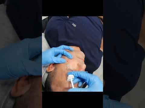 Belotero Injections For Smooth Facial Lines And Wrinkles in Plantation, Florida #shorts #belotero