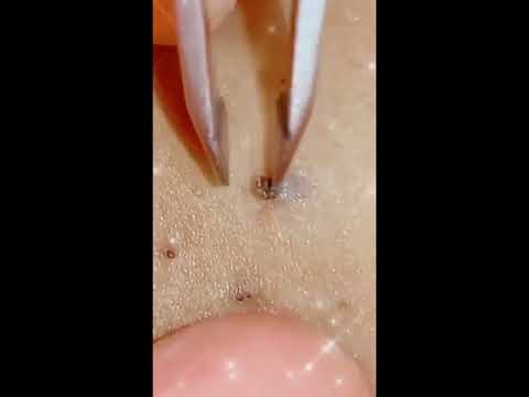 blackheads new this week