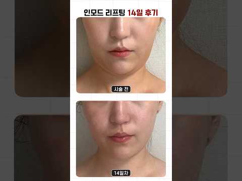 이중턱 없애고 턱라인 살아난 리프팅 실제 후기