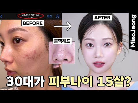 In my 30s, how old is my skin? Why is my acne skin better? (Remove small acne & sebum & blackheads)