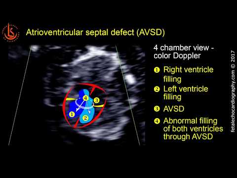 Fetal echocardiography at 11-13 weeks: Atrioventricular Septal Defect (AVSD)