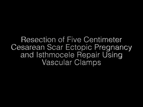 Resection of Five Centimeter Cesarean Scar Ectopic Pregnancy and Isthmocele Repair Using Vascular...