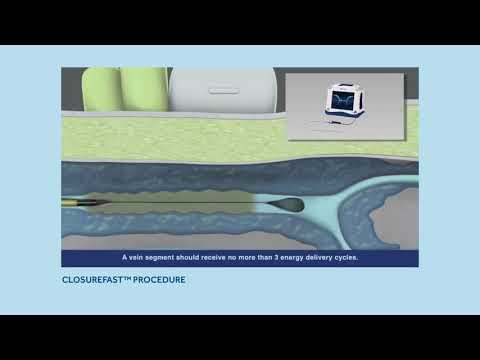 Endovascular Ablation video