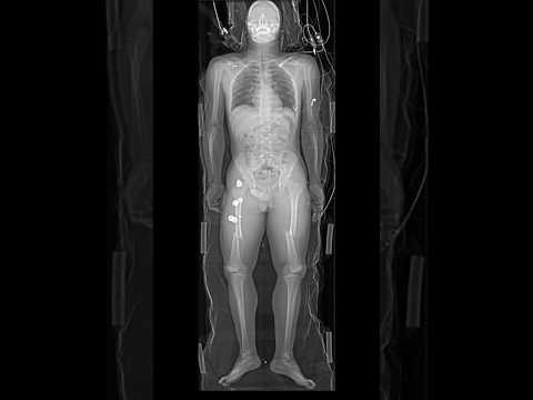 Whole Body X Ray Image