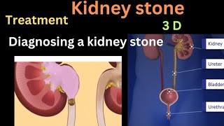 kidney stone treatment | symptoms | removal of kidney stone |  Surgery | fatima chem