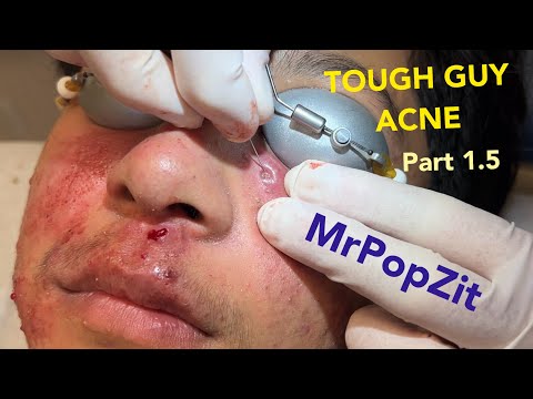 TOUGH GUY ACNE PART 1.5! So much inflammation! Acne extractions. So many pores cleared.