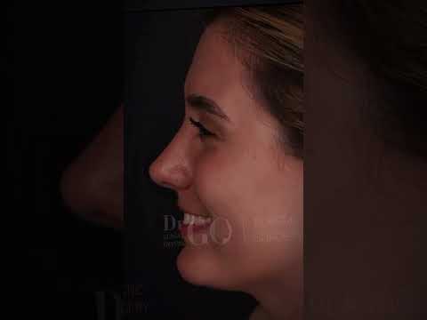 Rhinoplasty Transformation by Assoc. Prof. Dr. Güncel Öztürk | Before & After Results