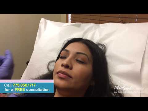 Facial Botox Injections - Reno Sparks MedSpa - Dr. Calvin Van Reken