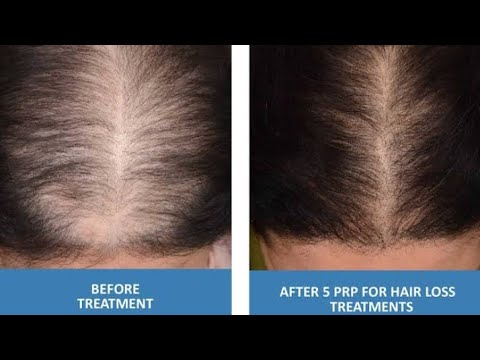 PRP Hair Treatment: The Secret to Regrowing Hair ! Prp