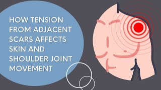 How tension from adjacent scars affects skin and shoulder joint movement