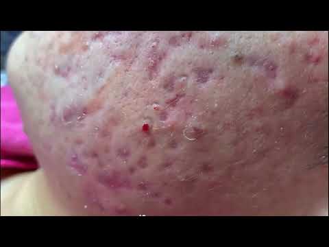 Blackheads Removal By Expert, Blackhead Extraction, Milia