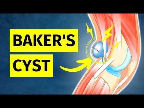 How to ACTUALLY Treat a Baker's Cyst (Pain Behind Knee)