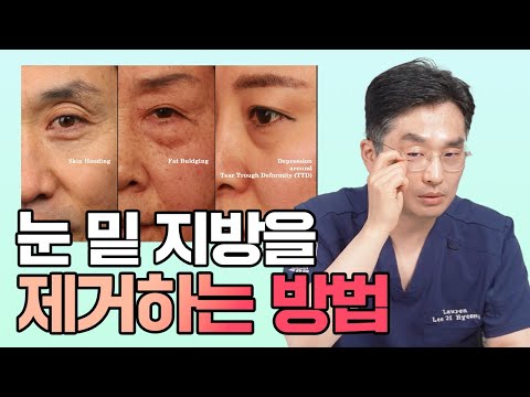 눈 밑 지방을 제거하는 방법