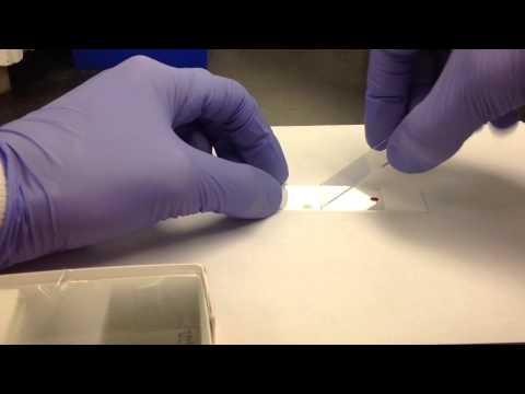 Hematology- Making a Peripheral Blood Smear