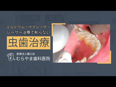 [むらやま歯科医院]レーザー治療で削らない虫歯治療